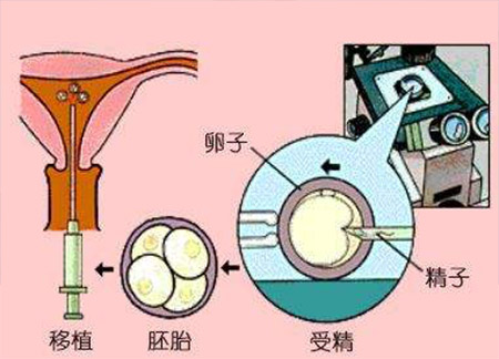 做借卵试管代怀医院一定需要促排卵吗？