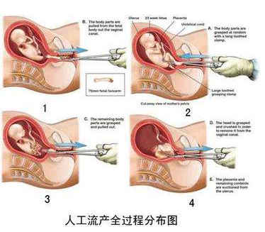 广州患输卵管畸形有什么症状+